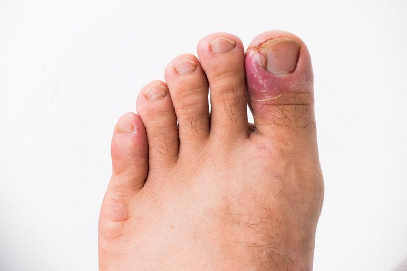 Avoiding Ingrown Toenails