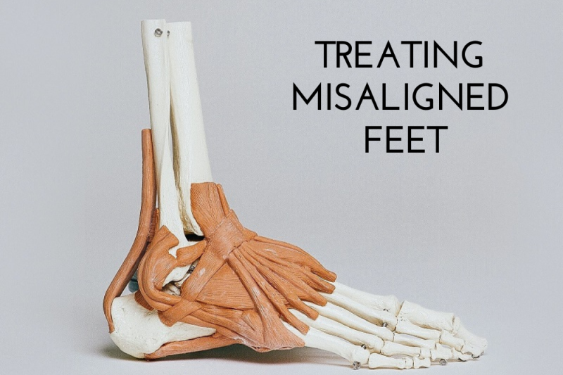 Treating Misaligned Feet